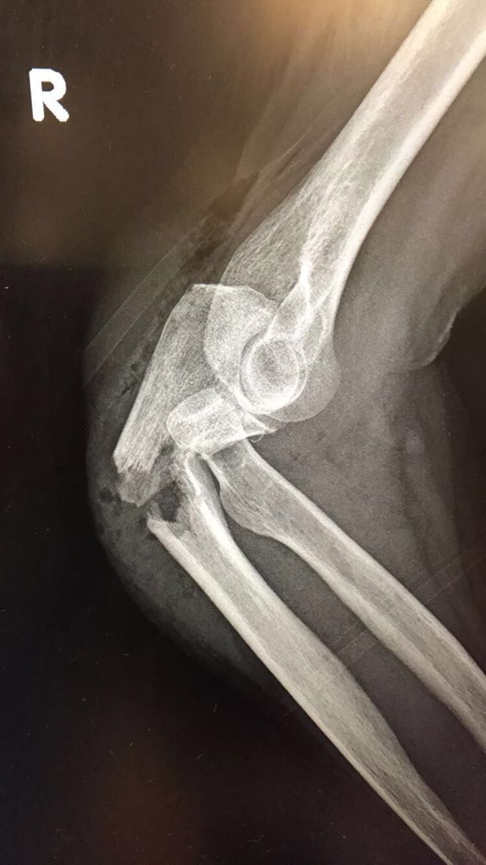 Fracture