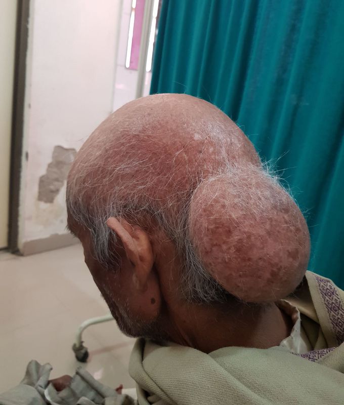 Lipoma