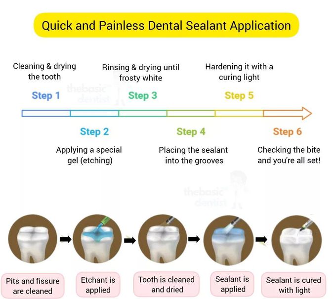 Pit and Fissure Sealants IV