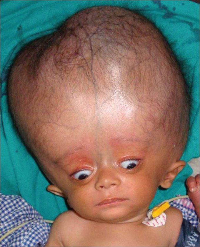 HYDROCEPHALUS