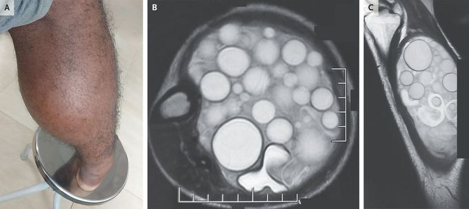 Echinococcal Cysts in the Leg