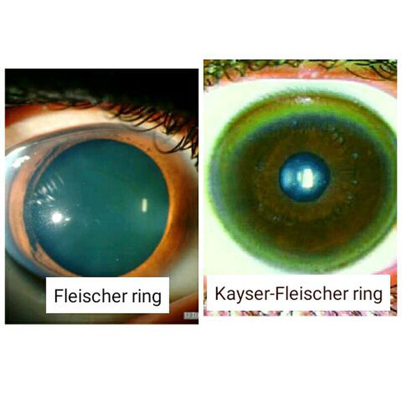 Perforatie Hijsen bereiden Fleischer rings and Kayser-Fleischer rings - MEDizzy