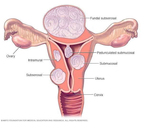 Symptoms Of Uterine Fibroids Medizzy