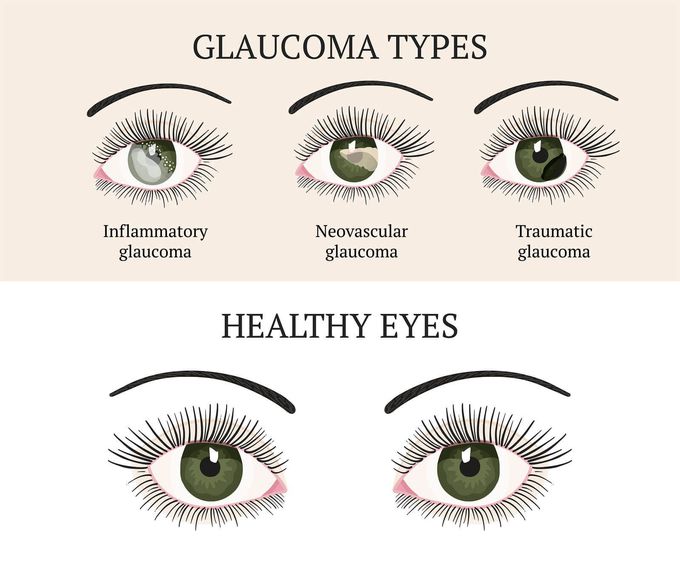 Symptoms of Glaucoma