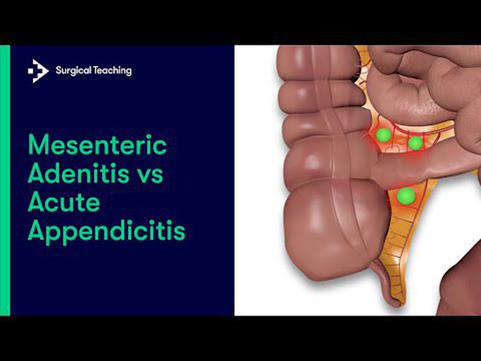 Mesenteric Adenitis vs Appendicitis