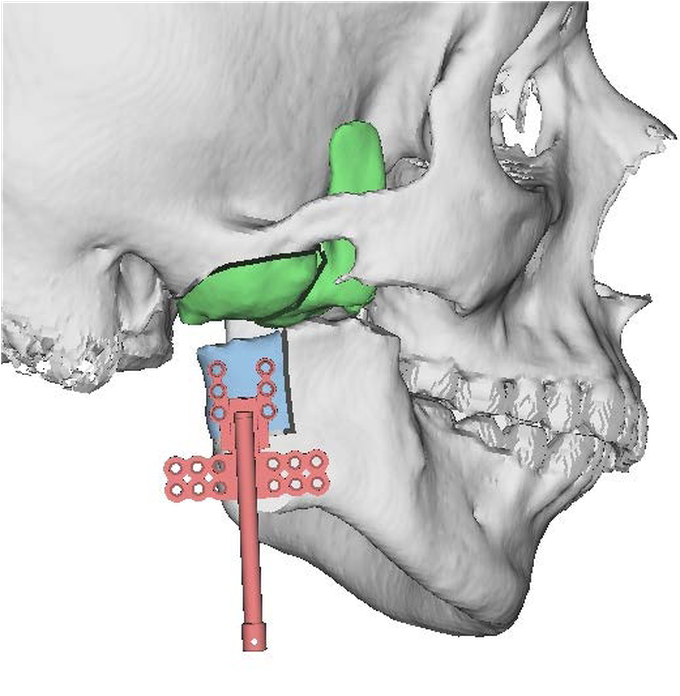 Treatment for Tmj ankylosis