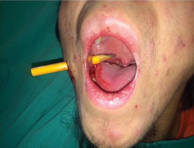 A 35-year-old male presented to the emergency room with a pencil penetrating his right cheek The pencil was self-inflicted