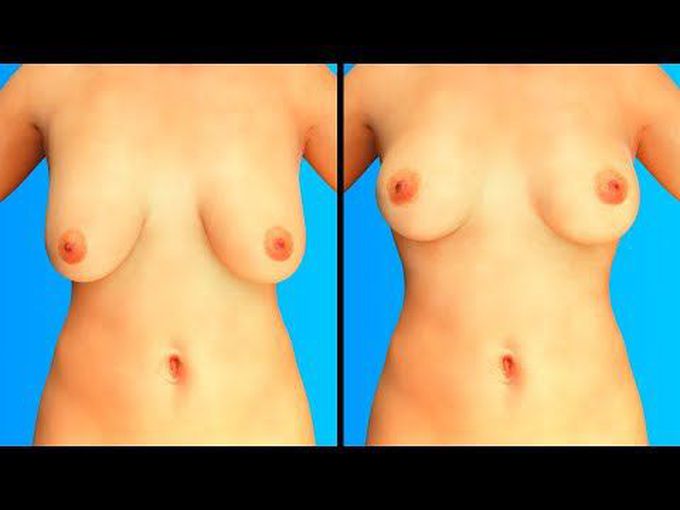 Breast Reconstruction-3D model