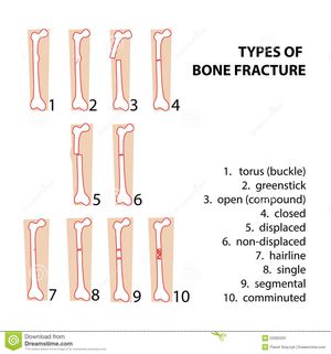 types of fracture - MEDizzy