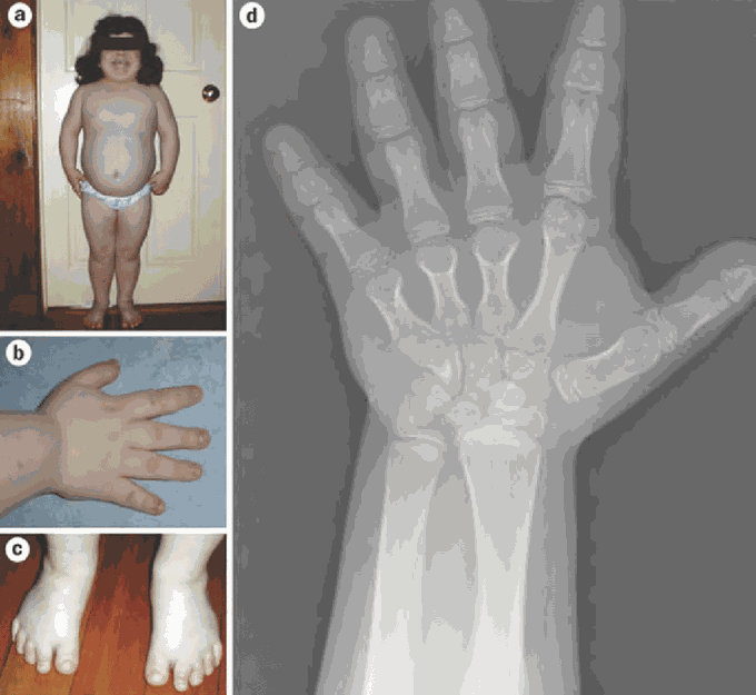 Albright’s Hereditary Osteodystrophy