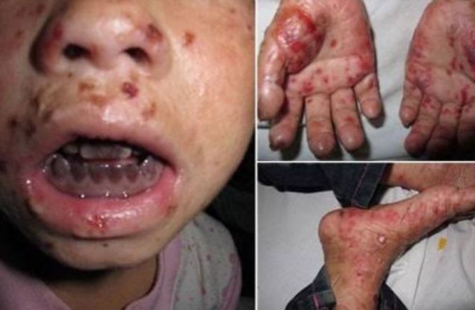 Erythropoietic protoporphyria