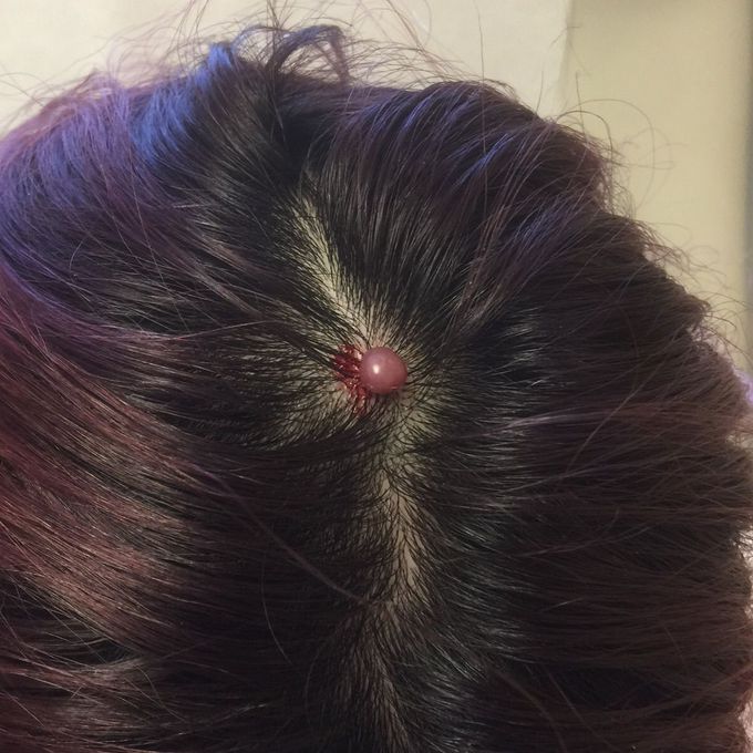 Benign Tumor
