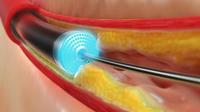 Laser Atherectomy