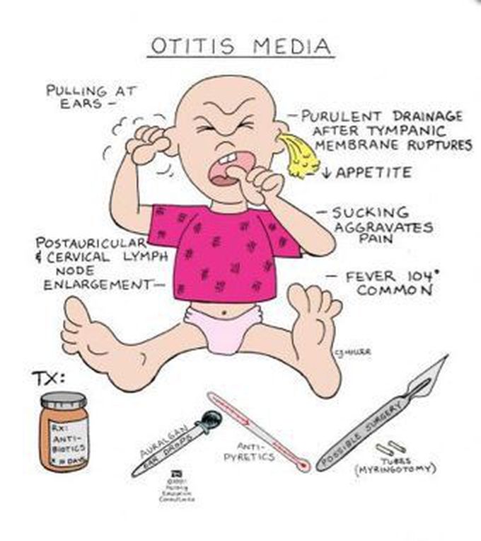 Otitis Media