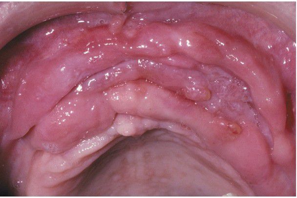 Epulis Fissuratum Histology Management Of Epulis Fissuratum