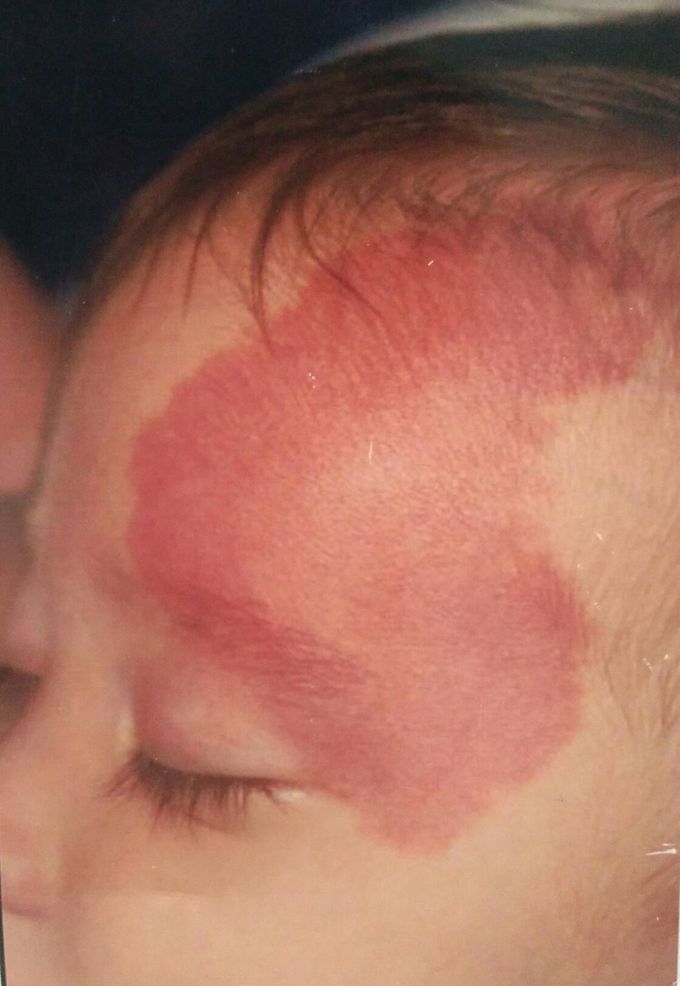 Sturge weber syndrome