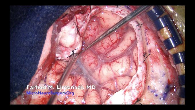 Brain Tumor Surgery: Resection of Glioblastoma Multiforme (GBM)
