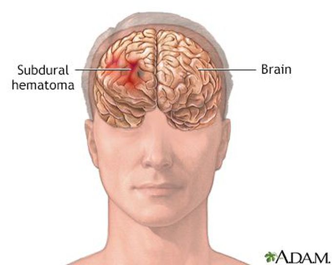 Subdural hemorrhage