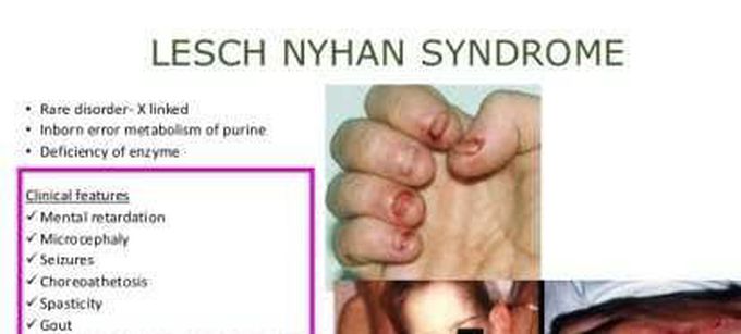 These are the clinical features of Lesch nyhan syndrome