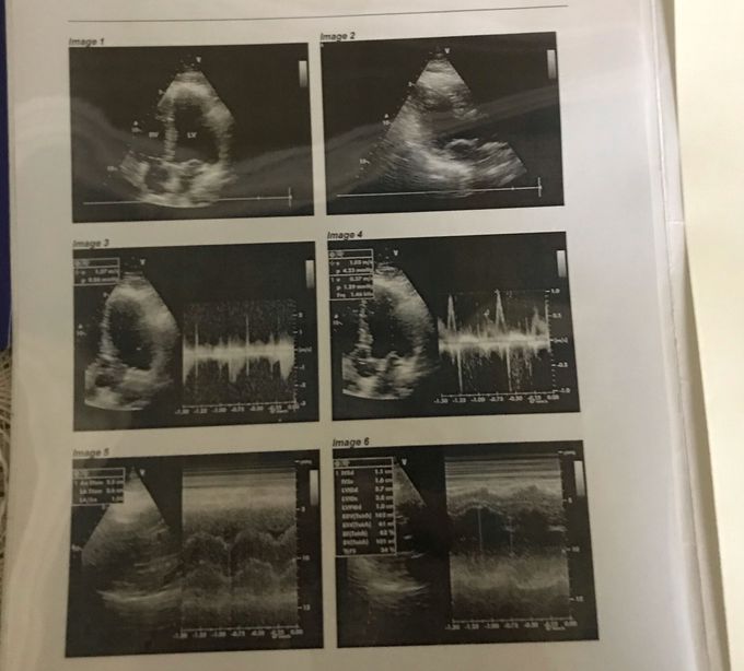 Echocardiogram report ? Diagnosis?