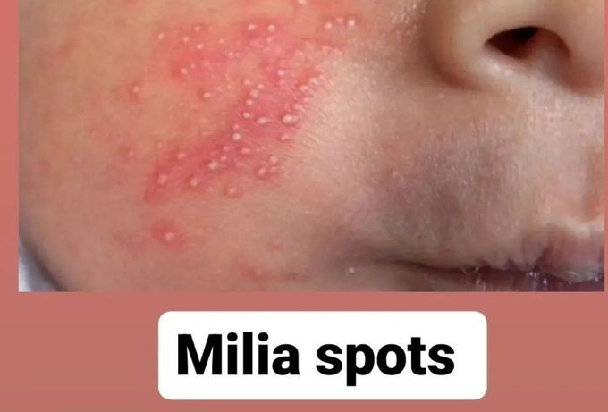 Milia Spots