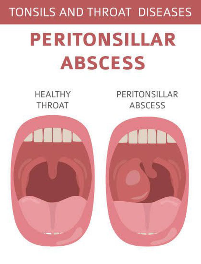 Peritonsillar abscess