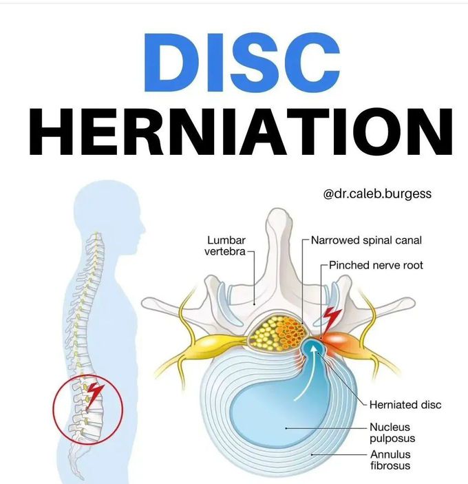 Disc Herniation