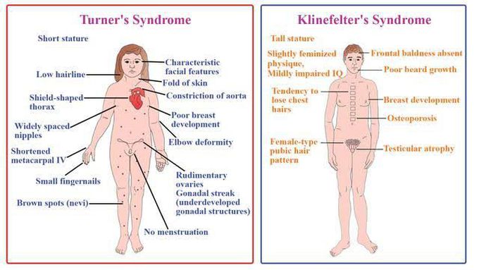 Turner's Syndrome and Klinefelter's Syndrome