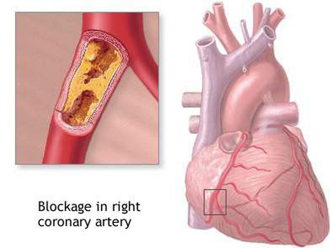 What is hypercholesterolemia?