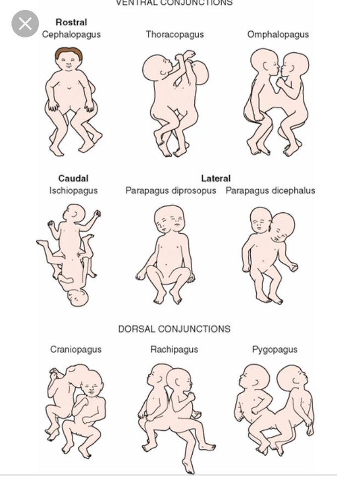 Types of conjoint twins