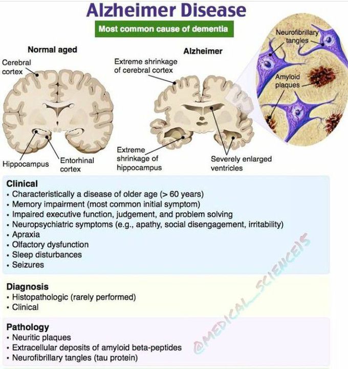 Alzheimer's Disease