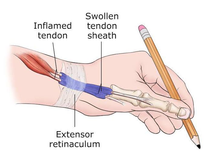 Dequervain tenosynovitis