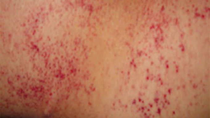 symptoms of petechiae