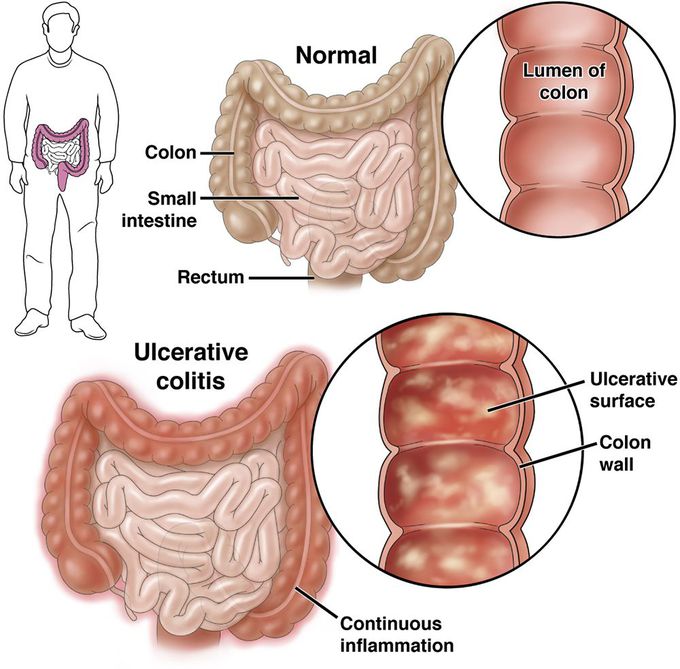 Ulcerative colitis