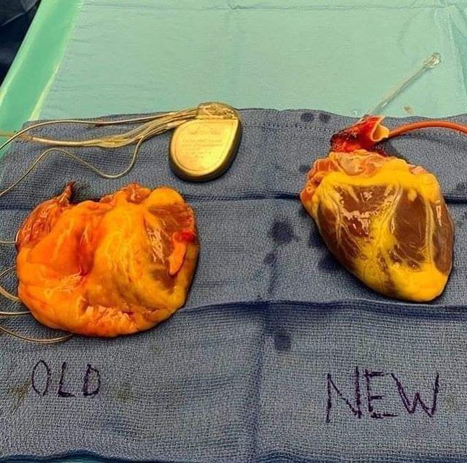 Heart transplant 🫀