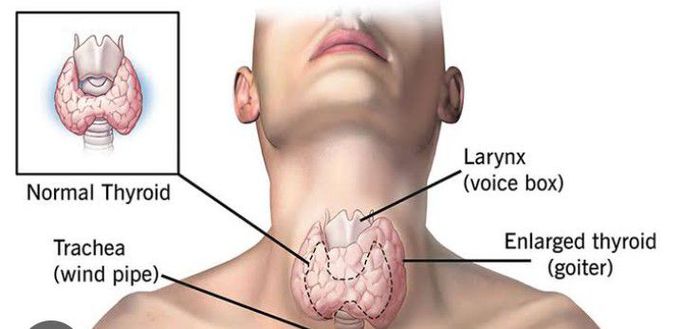 Thyrotoxicosis