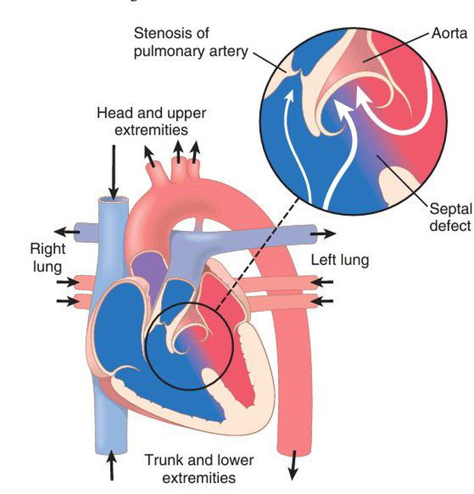 Tetralogy of Fallot