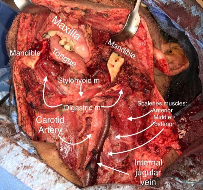 Head And Neck Anatomy-II