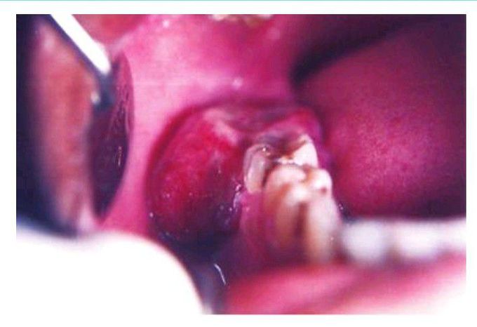 Peripheral giant cell granuloma