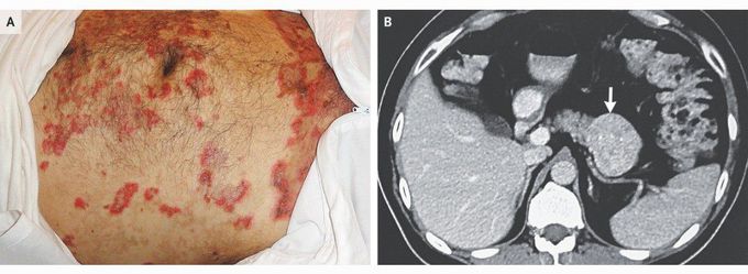 Necrolytic Migratory Erythema Associated with a Glucagonoma