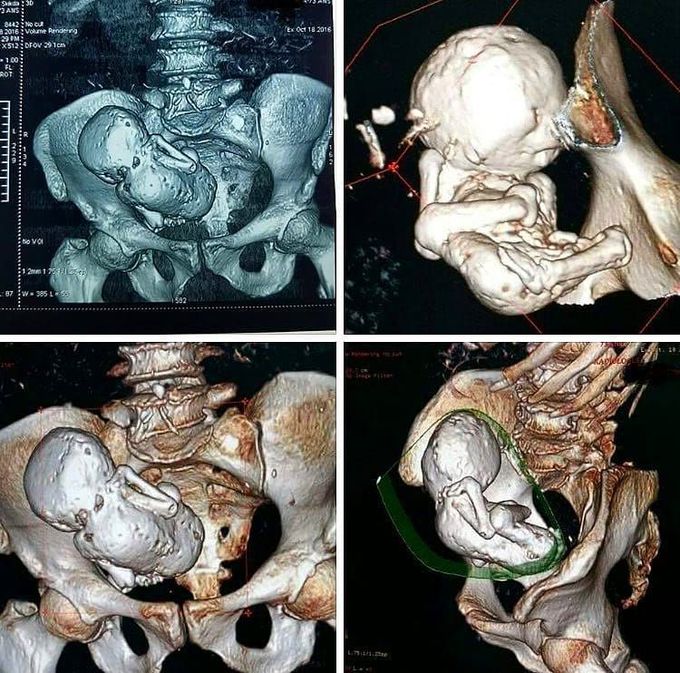Doctors found a calcified fetus of 30 years old in the uterus of a woman aged 73 years old!!