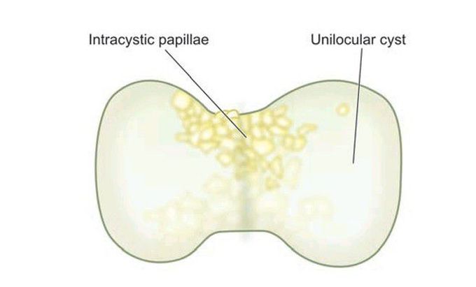 Papillary serous cystadenocarcinoma of the ovary