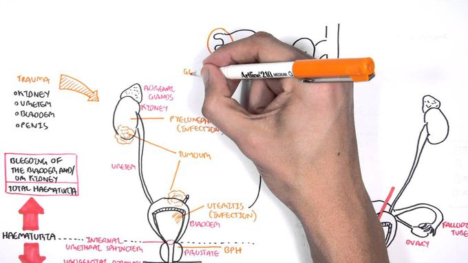 Causes of Haematuria