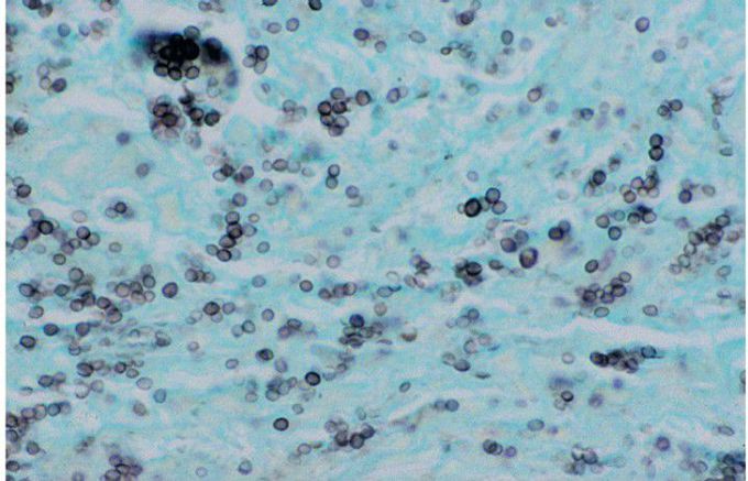 Histoplasmosis