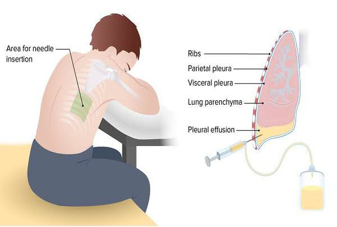 Pleural Tap