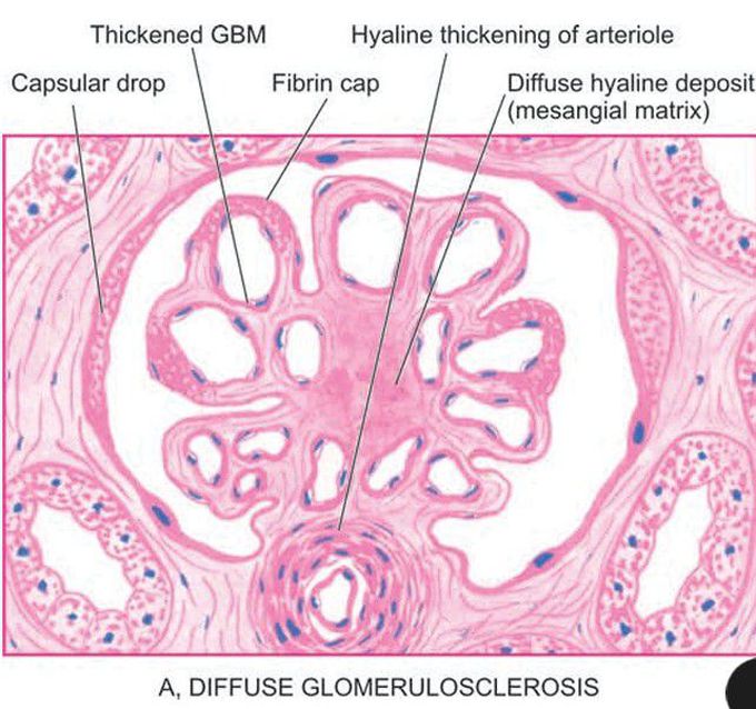 Diabetic glomerulosclerosis