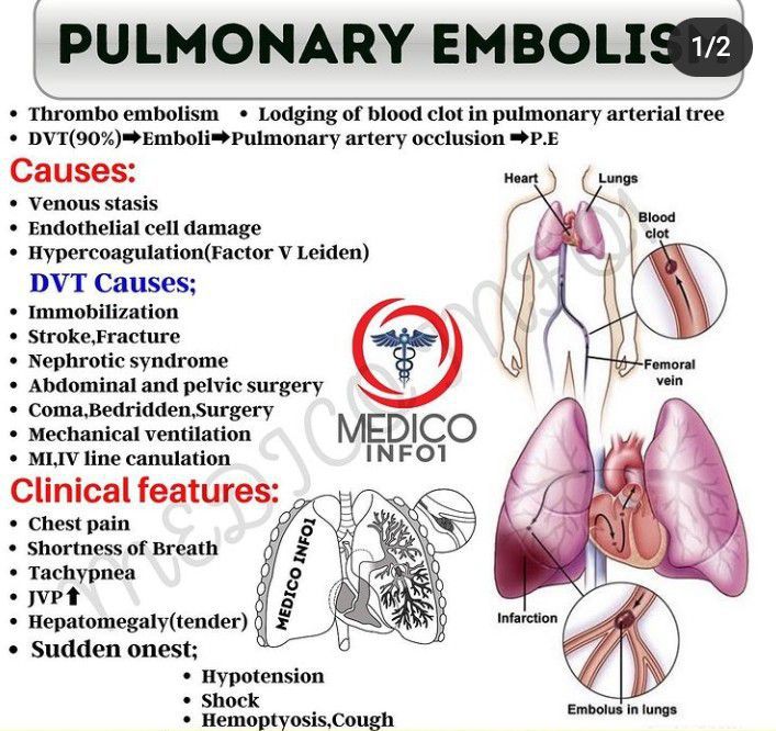 pulmonary embolism - MEDizzy