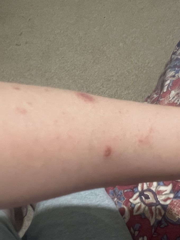 spots/ rashes on my both arms