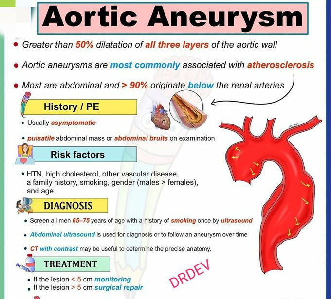 Aortic aneurysm - MEDizzy