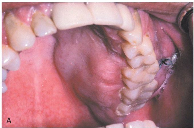 Osteosarcoma